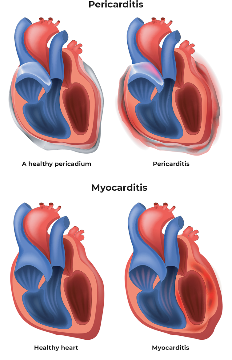 A heart diagram with an inflamed pericardium (pericarditis) next to a heart with inflammation showing myocarditis.